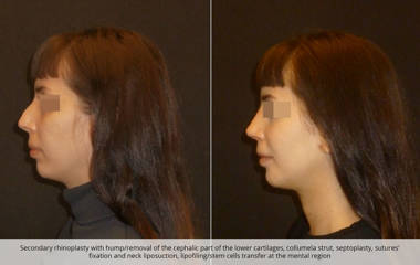 Side profile before and after secondary rhinoplasty, septoplasty, neck liposuction and stem cell grafting to the chin
