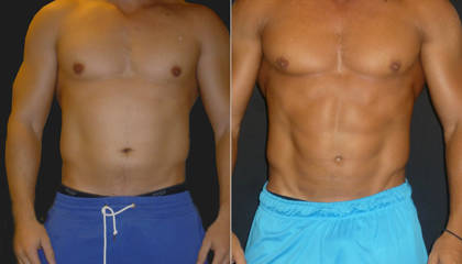 Before and after male abdominal liposuction showing improved torso contour and reduced flank fat