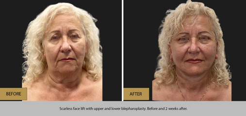 Before and 2 weeks after scarless face lift with upper and lower blepharoplasty