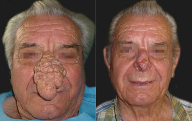 Before and after nasal reconstruction surgery showing removal of a large skin growth