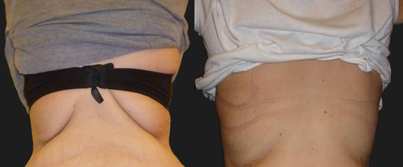 before and after mesotherapy lipolysis on the flanks showing reduced fat deposits and smoother side contour