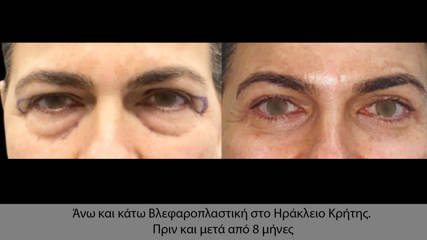 Blepharoplasty