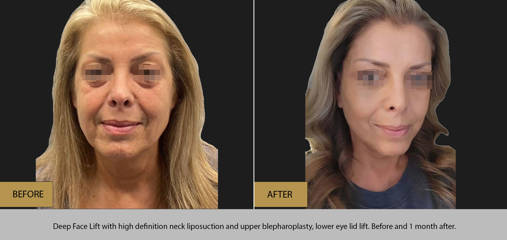 Before and 1 month after deep face lift with high-definition neck liposuction and upper and lower eyelid lift