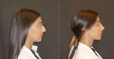 Side profile before and after surgical rhinoplasty showing refined nasal bridge and improved facial harmony