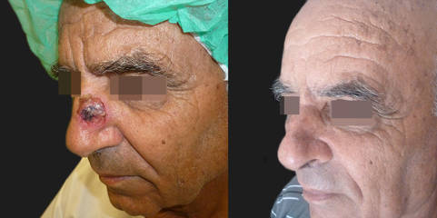 Before and after nasal skin cancer excision and reconstructive healing, with smooth restored skin contour