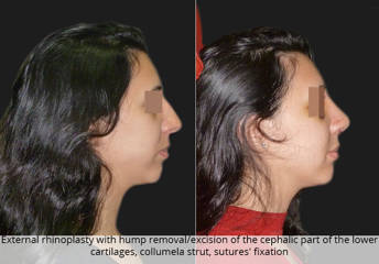 Side profile before and after external rhinoplasty with hump removal, cartilage excision, columella strut and suture fixation