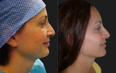 Before and after rhinoplasty side profile showing refined nasal shape and natural facial balance