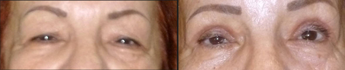 Before and after upper blepharoplasty showing correction of droopy eyelids and a more open, refreshed look