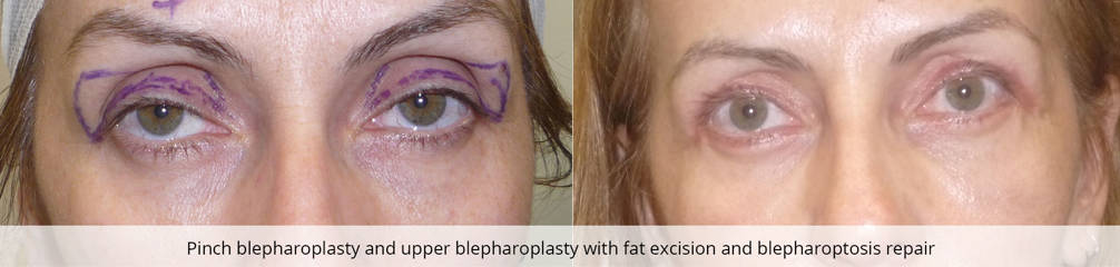 Before and after pinch and upper blepharoplasty with fat excision and blepharoptosis correction showing brighter, rejuvenated eyes