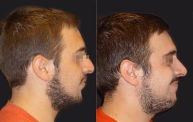 Side profile before and after male rhinoplasty showing correction of nasal bridge and improved profile symmetry