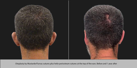 Before and after otoplasty by Mustarde/Furnas sutures and helix periosteum sutures at the top of the ears