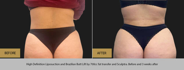 Before and after high-definition liposuction and Brazilian Butt Lift showing sculpted waist and lifted contour