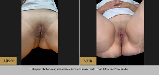 Labiaplasty by trimming labia minora, stem cells transfer and G Shot, before and 2 weeks after