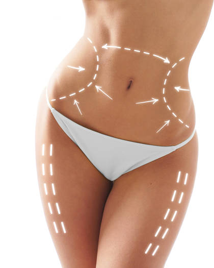 Illustration of body contouring treatment areas with white guide lines of abdomen, waist, and thighs