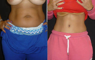 Before and after abdominoplasty showing flatter abdomen and improved waistline