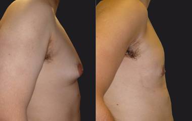 Side view before and after gynecomastia removal showing flatter, more masculine chest contour