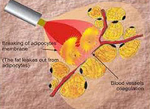 Diagram showing how laser therapy targets fat tissue, breaking adipocyte membraned and coagulating blood vessels to release fat