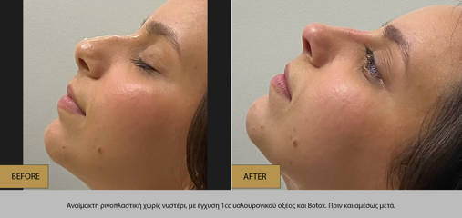 Non-surgical rhinoplasty before and after using 1cc hyaluronic acid and Botox to refine nasal contour