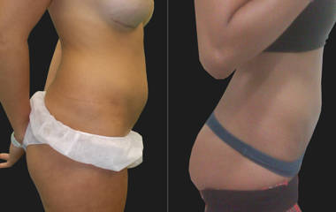 Side view before and after abdominal liposuction showing flatter stomach and improved contour