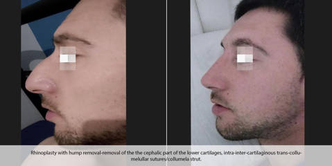 Male profile before and after rhinoplasty with dorsal hump removal and cartilage restructuring