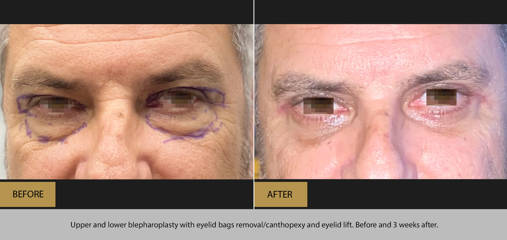 Before and after upper and lower blepharoplasty with eyelid bag removal, canthopexy, and eyelid lift