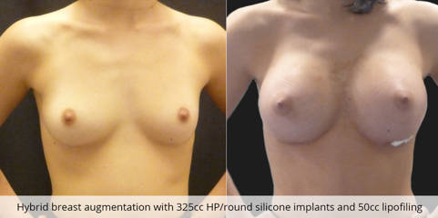 Before and after hybrid breast augmentation with 325cc HP/round silicone implants and 50cc lipofiling