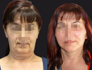 Before and after facelift showing enhanced jawline and neck contour with natural-looking rejuvenation