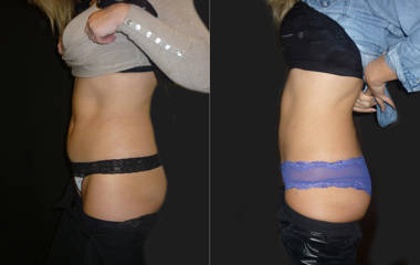Before and after abdominal liposuction showing a flatter, toned stomach and improved body contour