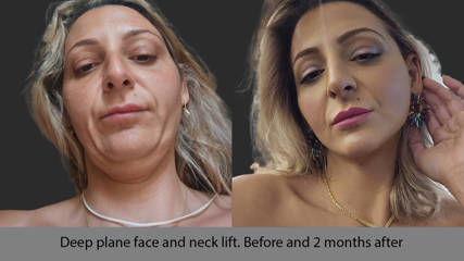 Scarless Face Lift10