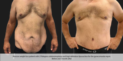 Before and after male body contouring surgery showing improved torso and slimmer waist