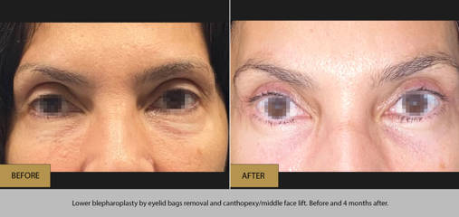 Before and after lower blepharoplasty with eyelid bag removal and canthopexy facelift showing refreshed eye contour