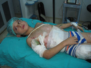 Young patient with burn injuries receiving post operative care