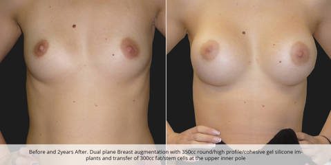 Before and after 2 years of dual plane breast augmentation with 350cc silicone implants and transfer of 300cc fat