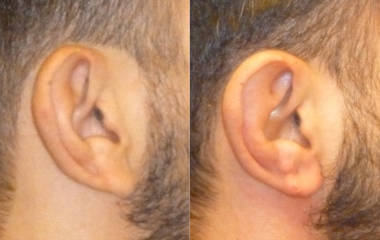 Close up of male ear before and after otoplasty showing improved ear position and natural contour