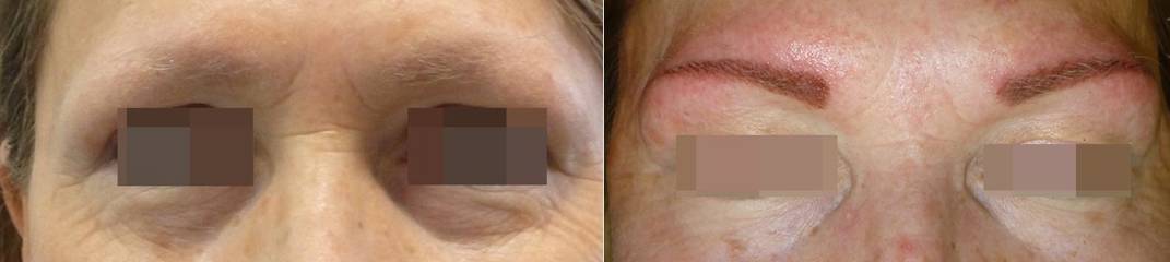 before and after eyebrow micropigmentation showing refined brow shape and enhanced symmetry