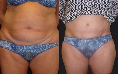 Female abdominoplasty before and after surgery showing tighter abdomen and smoother skin contour