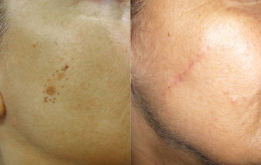 Close up on the cheek area showing before and after removal of a skin nevus