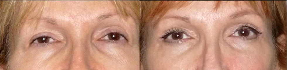 Before and after upper blepharoplasty showing lifted eyelids and brighter, more youthful eye appearance 