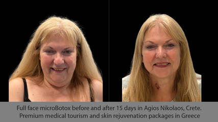 MicroBotox σε όλο το πρόσωπο: αποτελέσματα πριν και μετά από 15 ημέρες στον Άγιο Νικόλαο Κρήτης. Υψηλού επιπέδου ιατρικός τουρισμός και πακέτα αναζωογόνησης δέρματος στην Ελλάδα!
