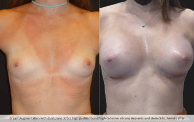 Breast augmentation with dual plane 375cc high profile silicone implants and stem cells, 3 weeks after
