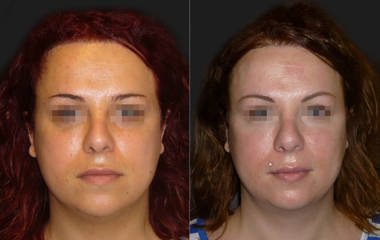Before and after eyebrow lift showing elevated brows and refined upper-face contour