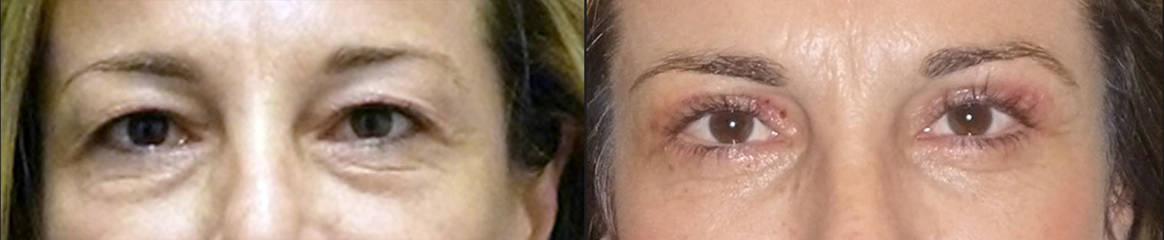 Before and after lower blepharoplasty showing smoother under-eye area and reduced puffiness