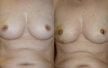 Before and after breast reduction with subtle reshaping and improved nipple position