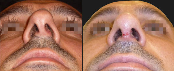 Before and after rhinoplasty showing correction of nasal asymmetry and improved nostril alignment