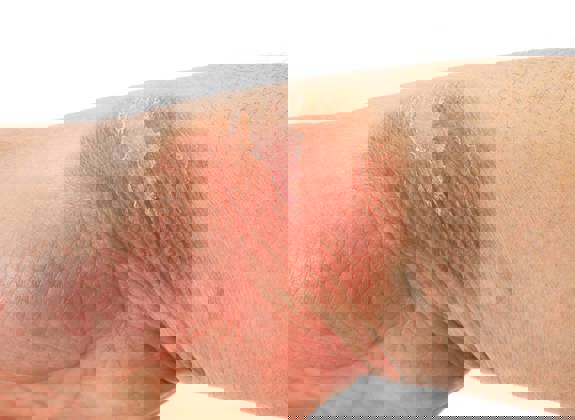 Close up of a mild skin burn on the hand showing redness and peeling