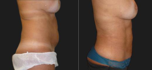 Side view before and after liposuction results, showing flatter stomach and improved contour