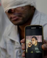 Patient showing pre injury photo after reconstructive facial surgery