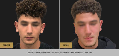 Before and one year after otoplasty by Mustarde/Furnas and helix periosteum sutures