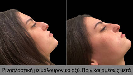 Rhinoplasty81