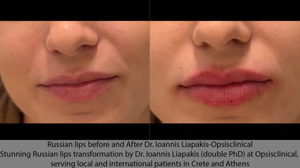 Russian Lips πριν και μετά – Dr. Ιωάννης Λιαπάκης – Opsisclinical Εντυπωσιακή μεταμόρφωση χειλιών με την τεχνική Russian Lips από τον Dr. Ιωάννη Λιαπάκη (κάτοχο δύο διδακτορικών) στην Opsisclinical, για ασθενείς από την Ελλάδα και το εξωτερικό, σε Κρήτη και Αθήνα.